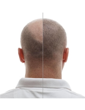 Tratamiento para barba y cabello crecimiento Minoxytop