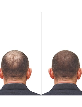 Tratamiento para barba y cabello crecimiento Minoxytop