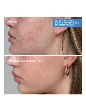 Sérum antiacné facial Bioma Balancing Clear & Prevent Murad todo tipo de piel