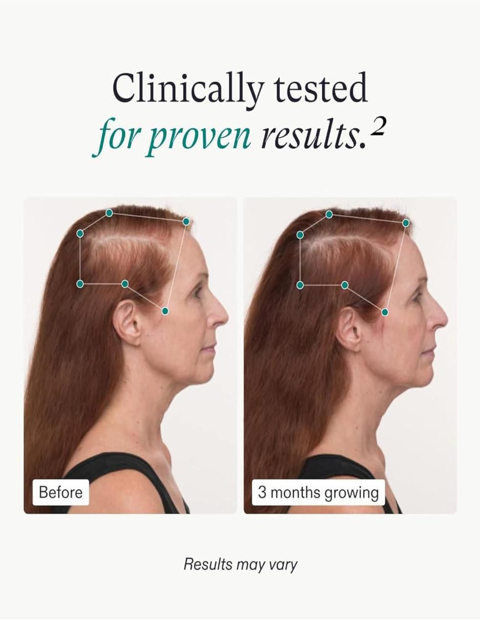 Suplemento para el crecimiento del cabello para mujeres con biotina, vitamina e de 120 cápsulas 4